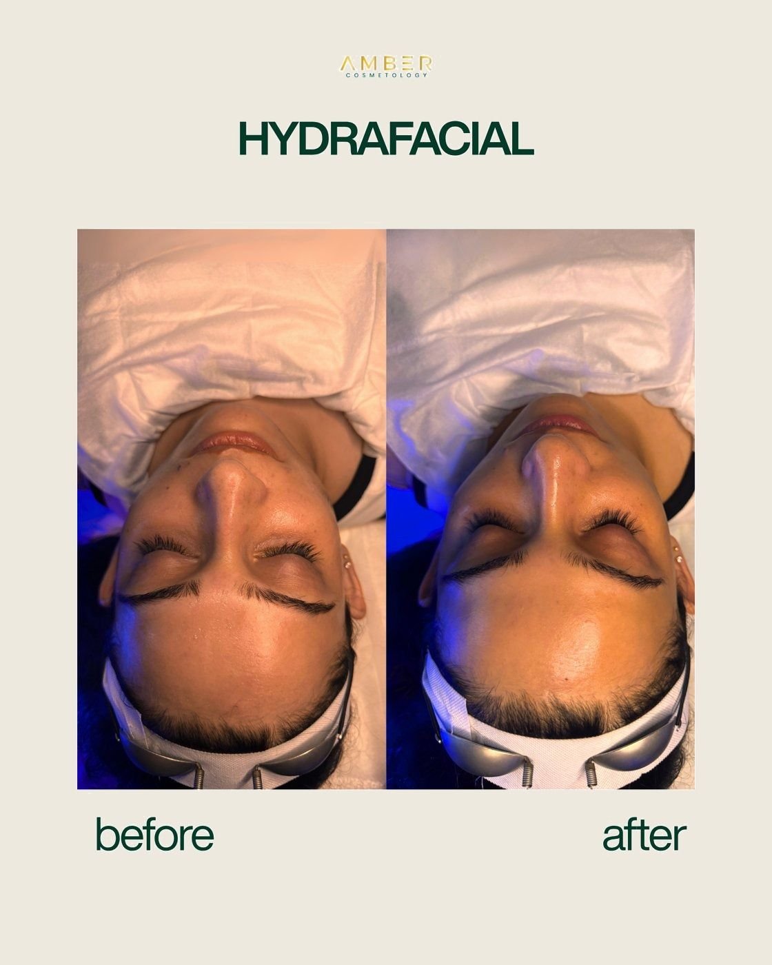 Before and after result at Amber Cosmetology, Lucknow