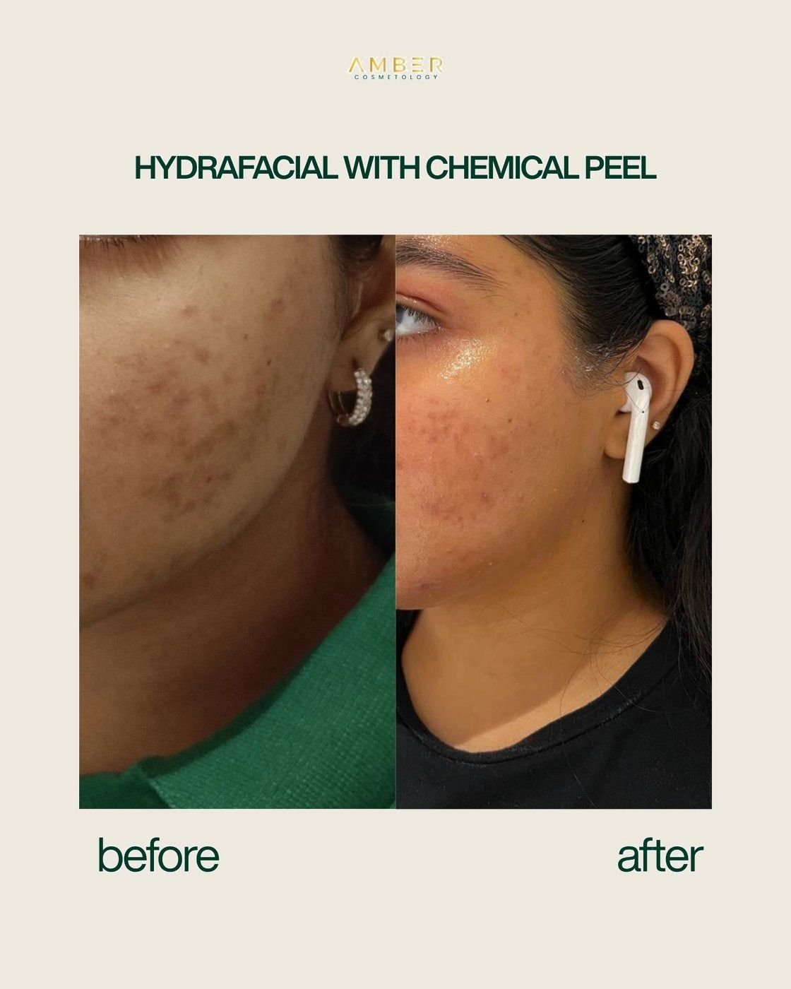 Before and after result at Amber Cosmetology, Lucknow