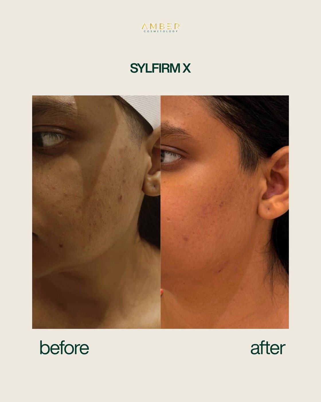 Before and after result at Amber Cosmetology, Lucknow