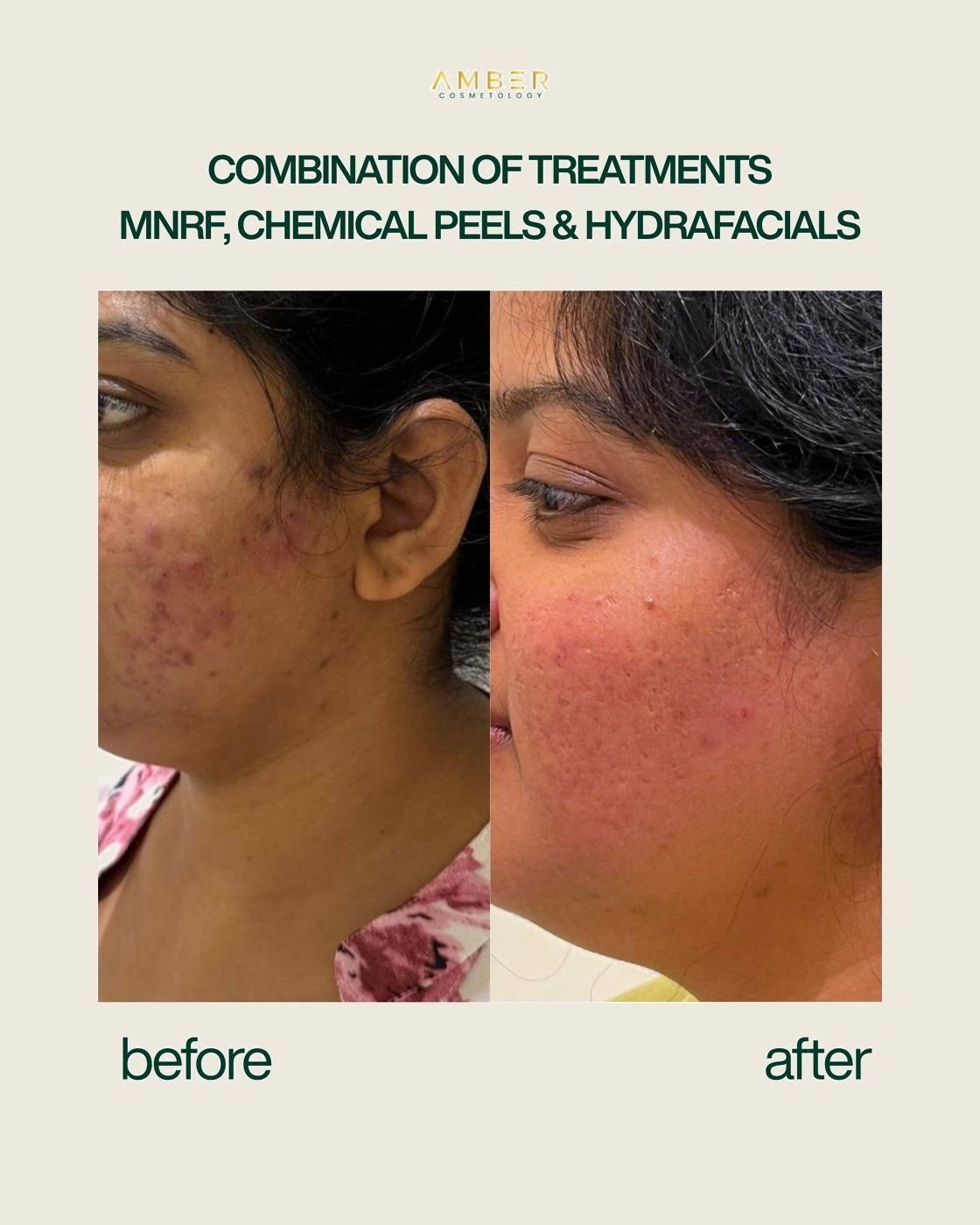 Before and after result, combination treatment, Amber Cosmetology