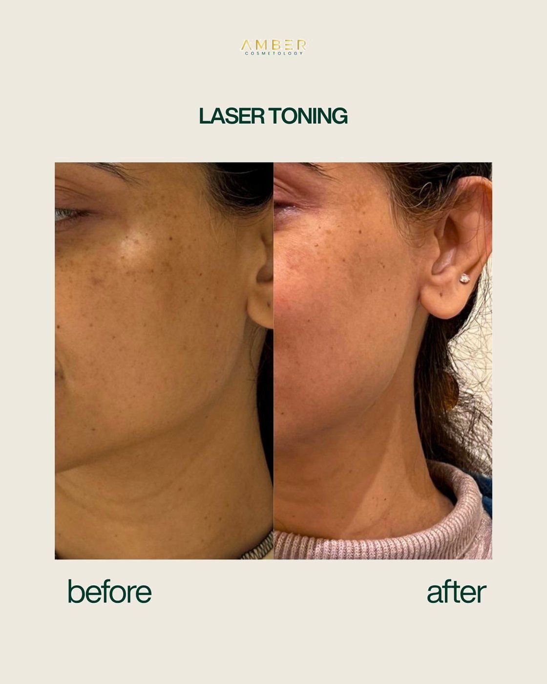 Before and after result at Amber Cosmetology, Lucknow