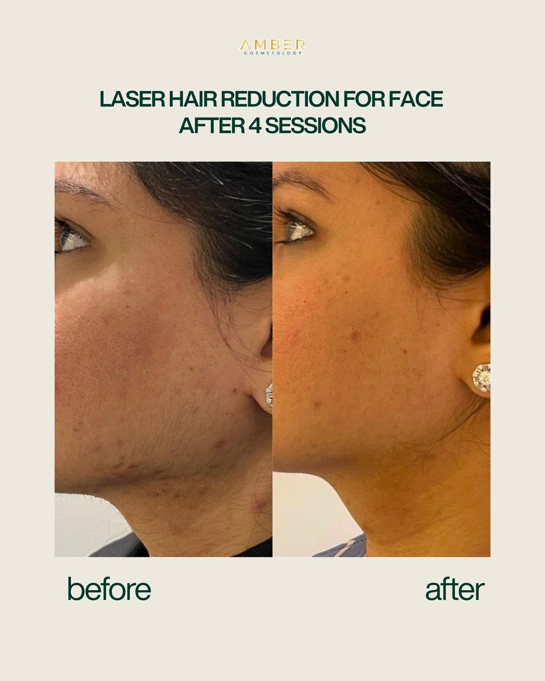 Before and after result at Amber Cosmetology, Lucknow