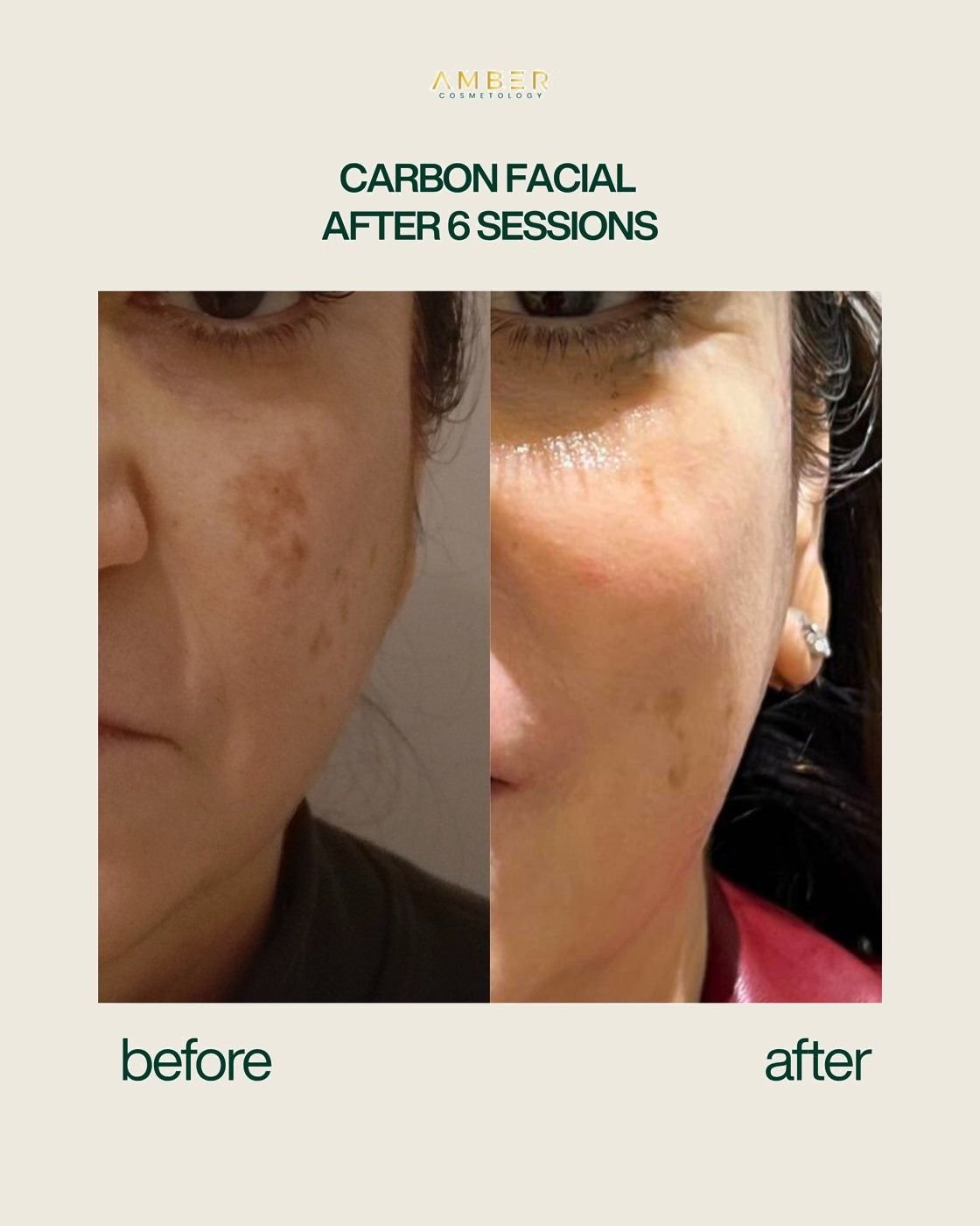 Before and after result at Amber Cosmetology, Lucknow