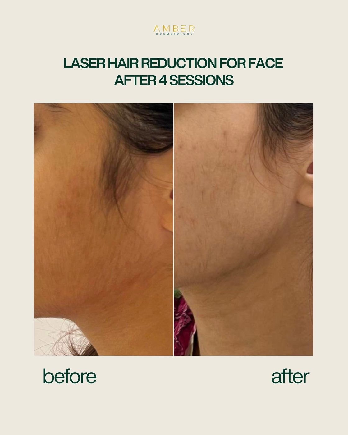 Before and after result at Amber Cosmetology, Lucknow
