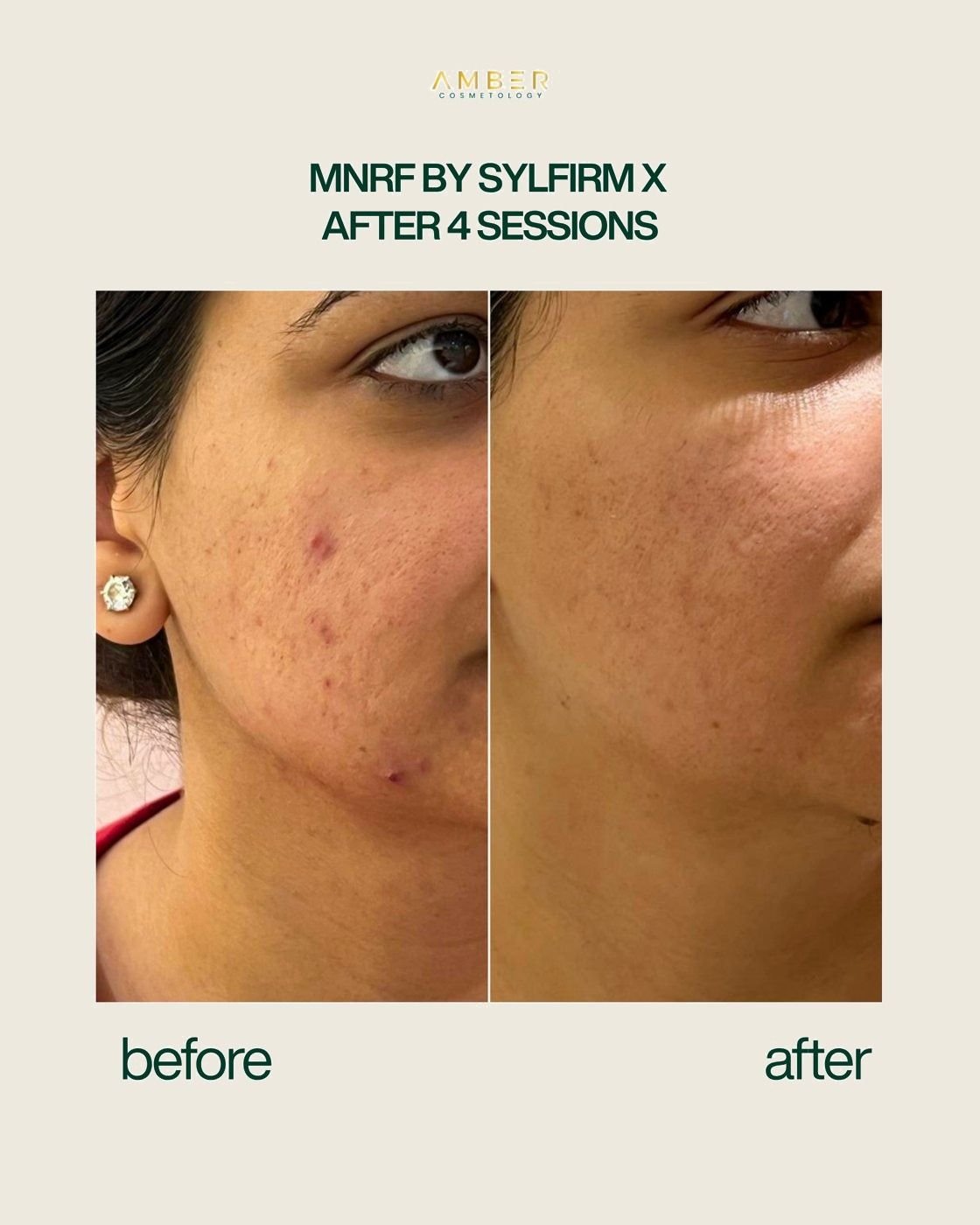 MNRF by Sylfirm X before and after, four sessions, Amber Cosmetology Lucknow