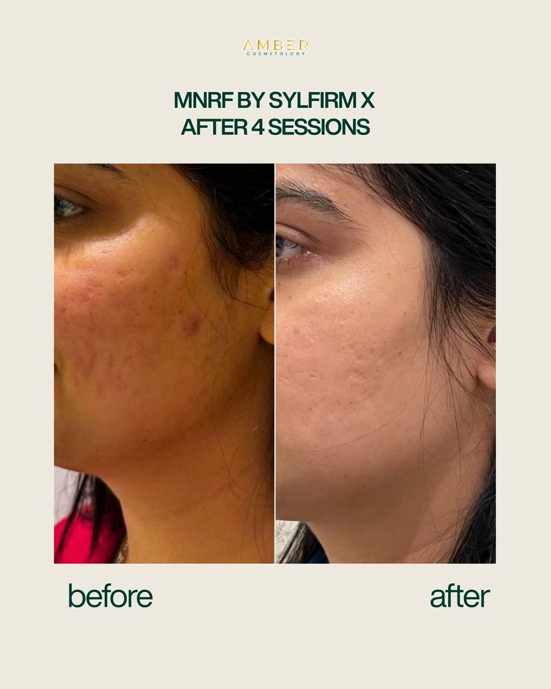 MNRF by Sylfirm X before and after, four sessions, at Amber Cosmetology, Lucknow