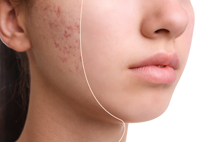 Top 7 Acne Treatments Recommended by the Best Dermatologists in Lucknow
