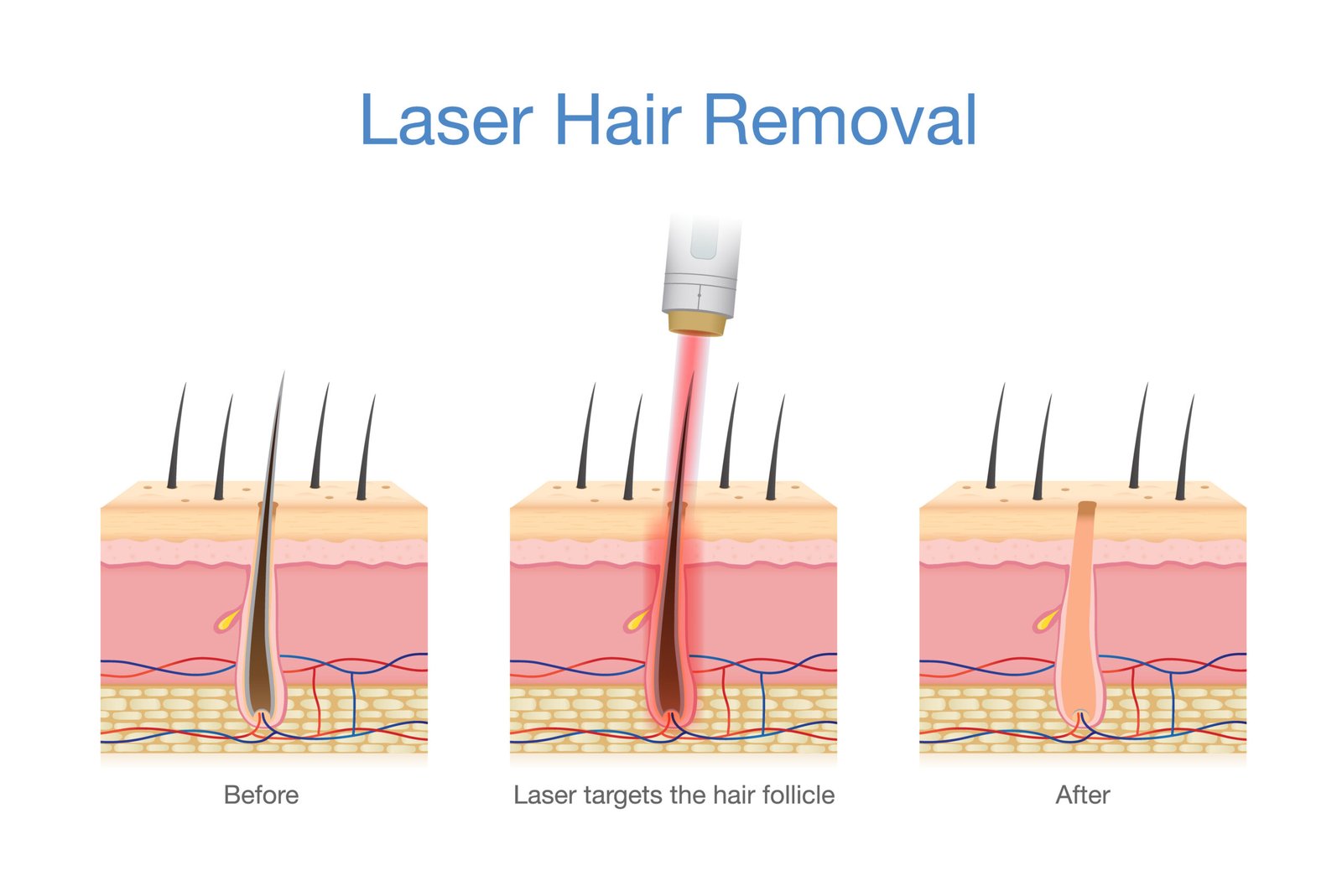 10 Tips for Laser Hair Removal Prep